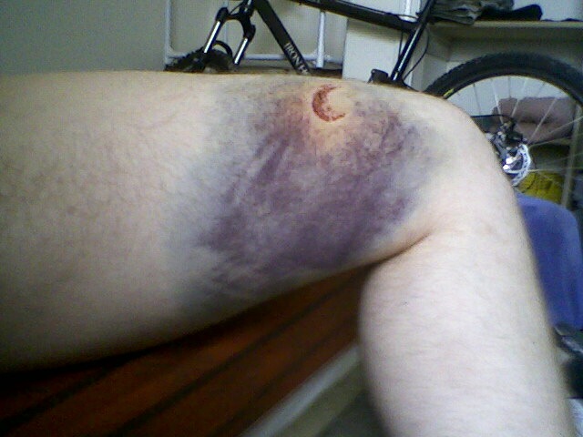 ugly bruise